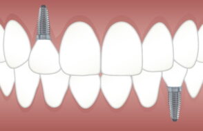 Fluoride Treatment in Dentistry - A Comprehensive Guide