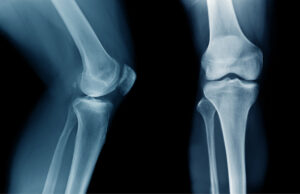 Reliable Ortho Doctors for Treating Fractures and Injuries
