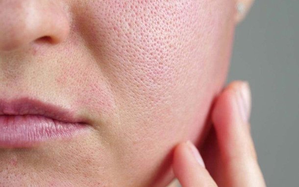 Strategies for Reducing Pores - A Comprehensive Guide