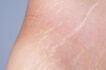 Deep Stretch Marks on Thighs and Belly during Pregnancy