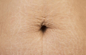 Fade Pregnancy Stretch Marks appear as Streaks or Lines on the Skin