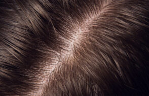 Natural Hair Plantation for Women of any Age no Surgery