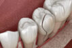 Is a Cracked Tooth a Dental Emergency?