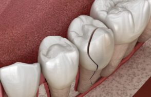Is a Cracked Tooth a Dental Emergency?
