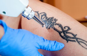 Laser Tattoo Removal: Complete Guide
