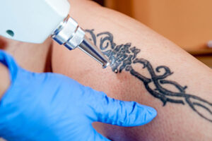 Laser Tattoo Removal: Complete Guide