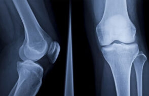 How Menopause affects Women's Bone Health