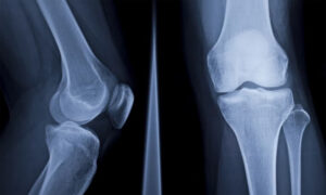 How Menopause affects Women's Bone Health